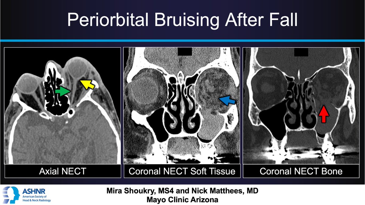 ASHNRSociety's tweet image. #ASHNRCOTW #301: ANSWER. Thx Mira Shoukry + Dr. Mathees 4 case! #ASHNR25
@callyrobs @DShatzkes @CDP_Rad @rhwiggins
@nakoontz @KRileyMD @CMGlastonbury @tabby_kennedy @PhilipRChapman1 @cmtomblinson
@amyfjuliano @bpoliceni @MohitTCCNeuro @AshokSrini15 @KatieTraylorDO…