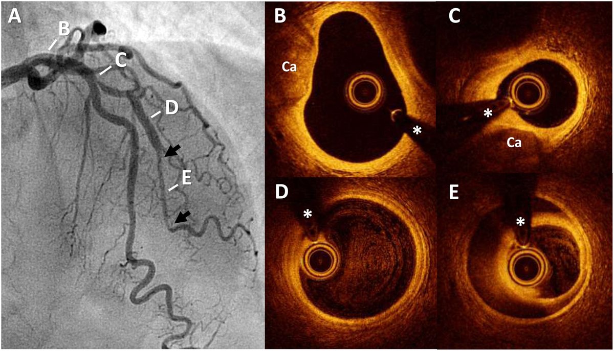 REC Publications (@revespcardiol) on Twitter photo Disección coronaria espontánea y enfermedad ateroesclerótica concomitante #REC <a href="/teresabastante/">Teresa Bastante</a>
revespcardiol.org/es-diseccion-c… Disección coronaria espontánea y enfermedad ateroesclerótica concomitante #REC <a href="/teresabastante/">Teresa Bastante</a>
revespcardiol.org/es-diseccion-c…