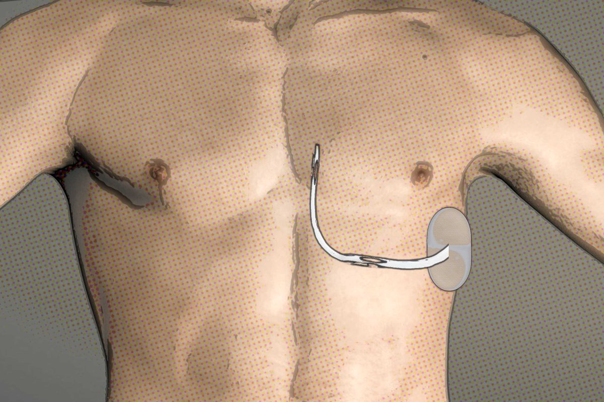 The IMJ (@the_imj) on Twitter photo IMJ June 2025 #FreeAccess
Original Article: Long-term outcomes of subcutaneous implantable cardioverter-defibrillators
bit.ly/4e0tEjf
<a href="/TheRACP/">The Royal Australasian College of Physicians</a> <a href="/WileyHealth/">Wiley Clinical Health</a> @SaurabhkumarEp IMJ June 2025 #FreeAccess
Original Article: Long-term outcomes of subcutaneous implantable cardioverter-defibrillators
bit.ly/4e0tEjf
<a href="/TheRACP/">The Royal Australasian College of Physicians</a> <a href="/WileyHealth/">Wiley Clinical Health</a> @SaurabhkumarEp