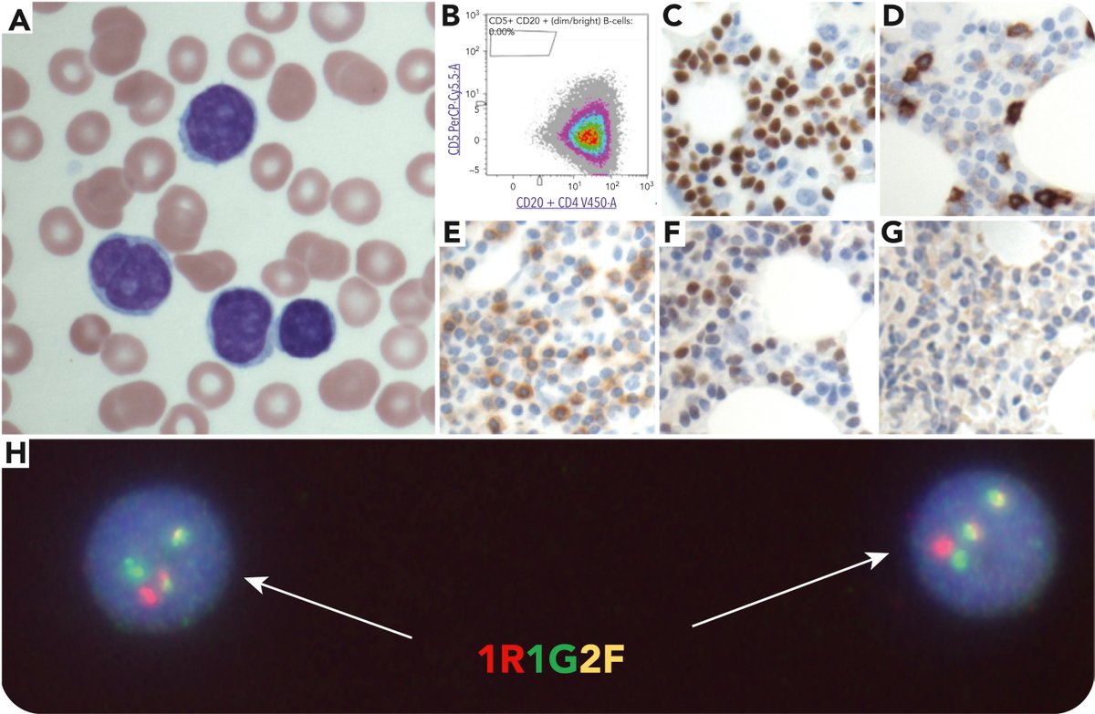 Peripheral blood flow cytometry was initially interpreted to be suggestive of marginal zone lymphoma. ow.ly/KnGl50W8NZr #BloodWork #lymphoidneoplasia