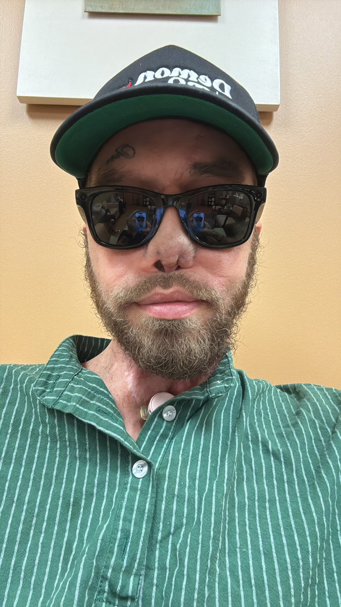 DaFeldster's tweet image. Chilling in Cincy bout to see my face doctor to see when my next reconstructive surgery is. Ain’t gonna lie it’s looking better. Might need one more lazor hair still some growing or I can grow another mullet 😂. It ain’t bad already did 3 lazor removals. Ya boi got thick hair