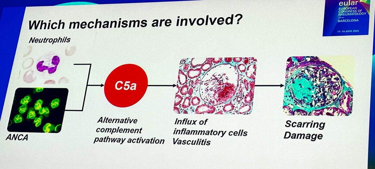 Simplistic overview of mechanisms involved in ANCA #Vasculitis 

#EULAR2025 #GPA #EGPA #MPA #AAV #ANCA