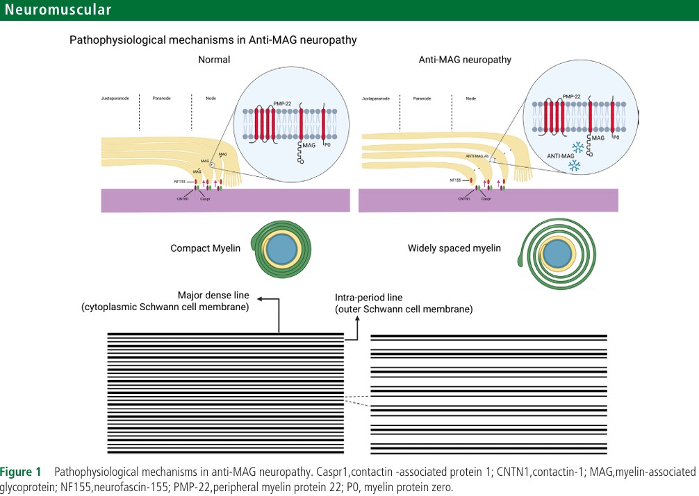 JNNP_BMJ's tweet image. Neuropathy with anti-myelin-associated glycoprotein antibodies: update on diagnosis, pathophysiology and management, by Min e al
jnnp.bmj.com/content/early/…