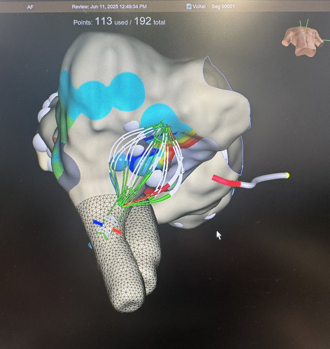 JRgar10's tweet photo. CTI ablation performed with VOLT  catheter and intracardiacEcho (ICE). @AbbottCardio @AbbottNews https://t.co/YcDdJvhDar