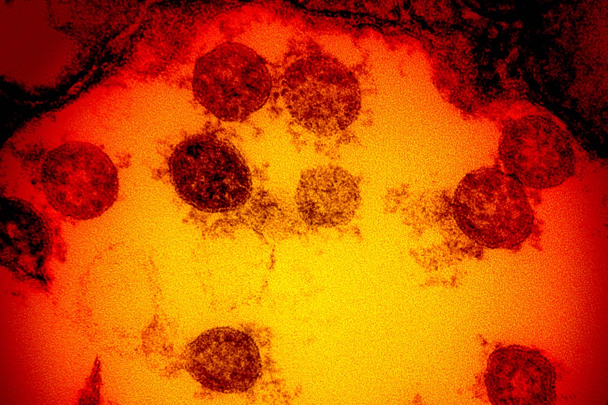 BiotechMN's tweet image. Dr. Agustín Muñoz-Sanz: "Numerosos expertos opinan que NB.1.8.1 no provocará un daño notable, a pesar de su actual difusión pluricontinental". #BiotechMN @sev_virologia @microBIOblog @microRyC @Mic_Inf_Maranon @saludenlared biotechmagazineandnews.com/sars-cov-2-la-…