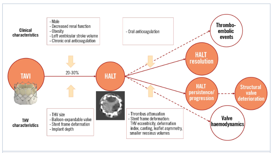 CT-based thrombus attenuation is independently associated with HALT resolution after #TAVI. Prosthesis deformation parameters (eccentricity, canting) also impact #HALT evolution. Imaging may support risk stratification and guide management. ow.ly/tZXb50VSacI #EAPCI