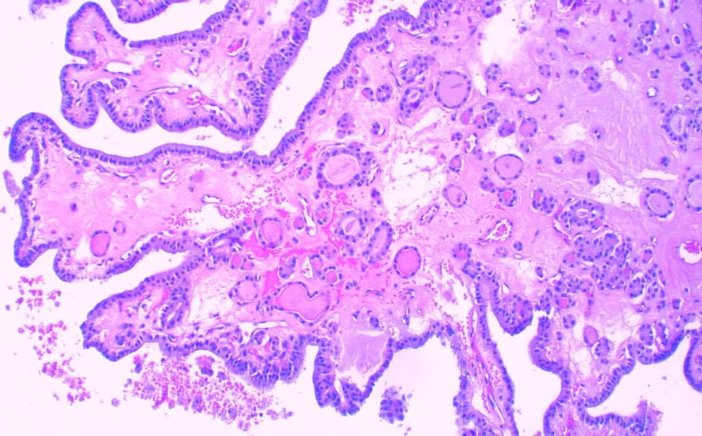 JCandidoXavier's tweet image. Papilla does not mean carcinoma in #thyroid #pathology
Nodules with cystic degeneration can show beautiful ones 😁
Nuclear features are mandatory.

#medicine #path #endocrine