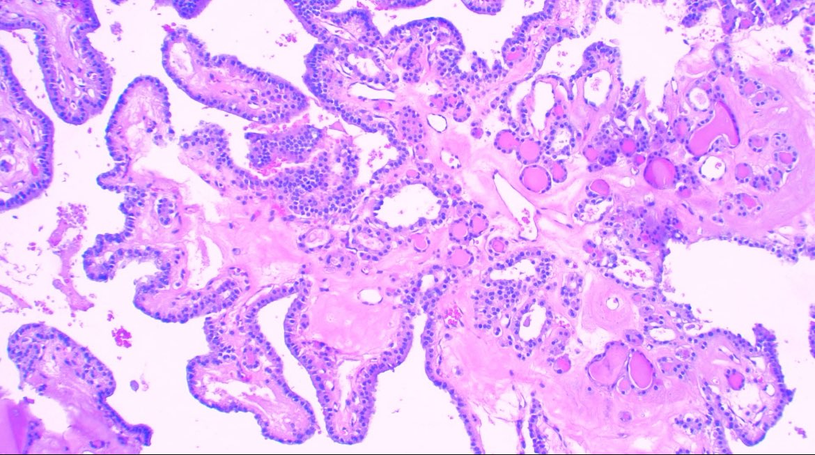 JCandidoXavier's tweet image. Papilla does not mean carcinoma in #thyroid #pathology
Nodules with cystic degeneration can show beautiful ones 😁
Nuclear features are mandatory.

#medicine #path #endocrine