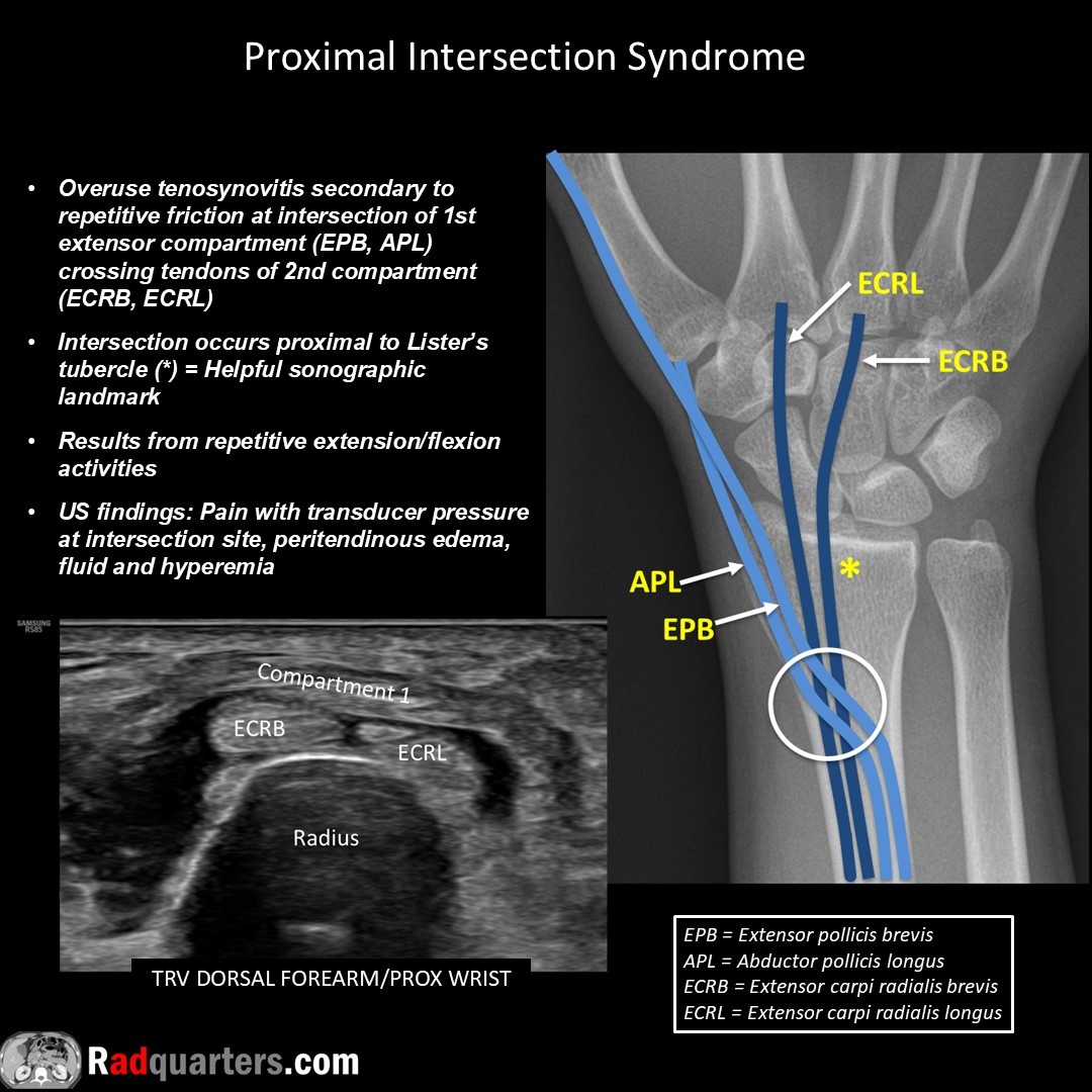 Radquarters's tweet image. 📽️ Watch video to learn more: youtu.be/4gyC2XqCqs4
#FOAMrad #FOAMed #mskrad #usrad #radres #radtech #medstudent #radquarters @BostonImaging @SamsungHealth