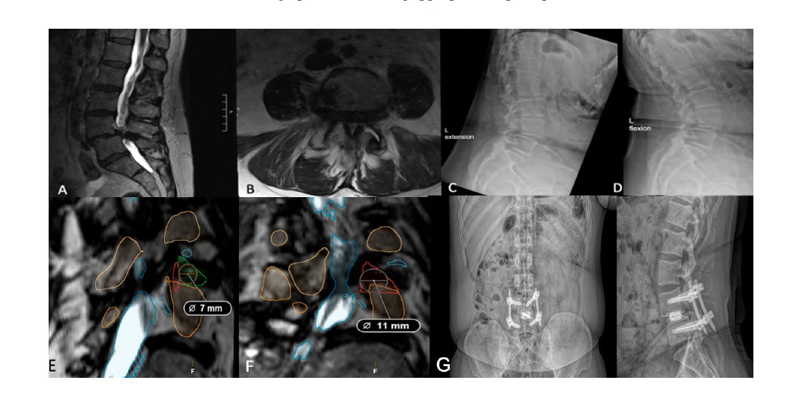 Muhammad Abd-El-Barr MD PhD FAANS (@abdelbarrspine) on Twitter photo pub:Ā Optimizing TLIF Approach Selection: An Algorithmic Framework with Illustrative Cases
mdpi.com/2077-0383/14/1ā¦
Because spine spine surgery should NOT be cookie-cutter.Ā Ā It needs to be patient- and pathology-specific.
HugeĀ congrats <a href="/DukeMedSchool/">Duke University School of Medicine</a>Ā <a href="/ambartlett5/">Alyssa Bartlett, MPH</a> Ā and team pub:Ā Optimizing TLIF Approach Selection: An Algorithmic Framework with Illustrative Cases
mdpi.com/2077-0383/14/1ā¦
Because spine spine surgery should NOT be cookie-cutter.Ā Ā It needs to be patient- and pathology-specific.
HugeĀ congrats <a href="/DukeMedSchool/">Duke University School of Medicine</a>Ā <a href="/ambartlett5/">Alyssa Bartlett, MPH</a> Ā and team