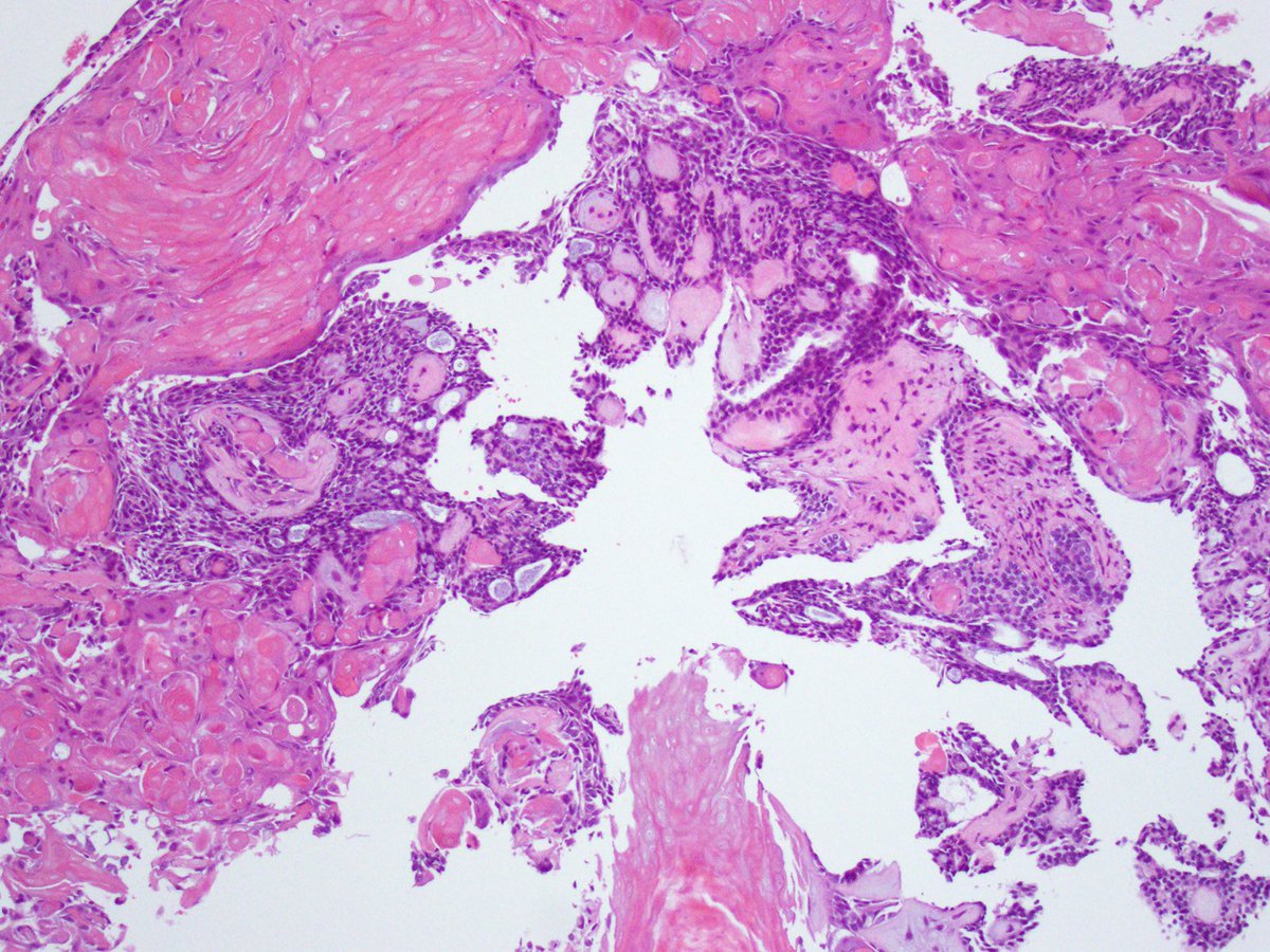 Cystic and solid suprasellar brain mass, what is the likely mutation? #pedipath #neuropath #molecpath