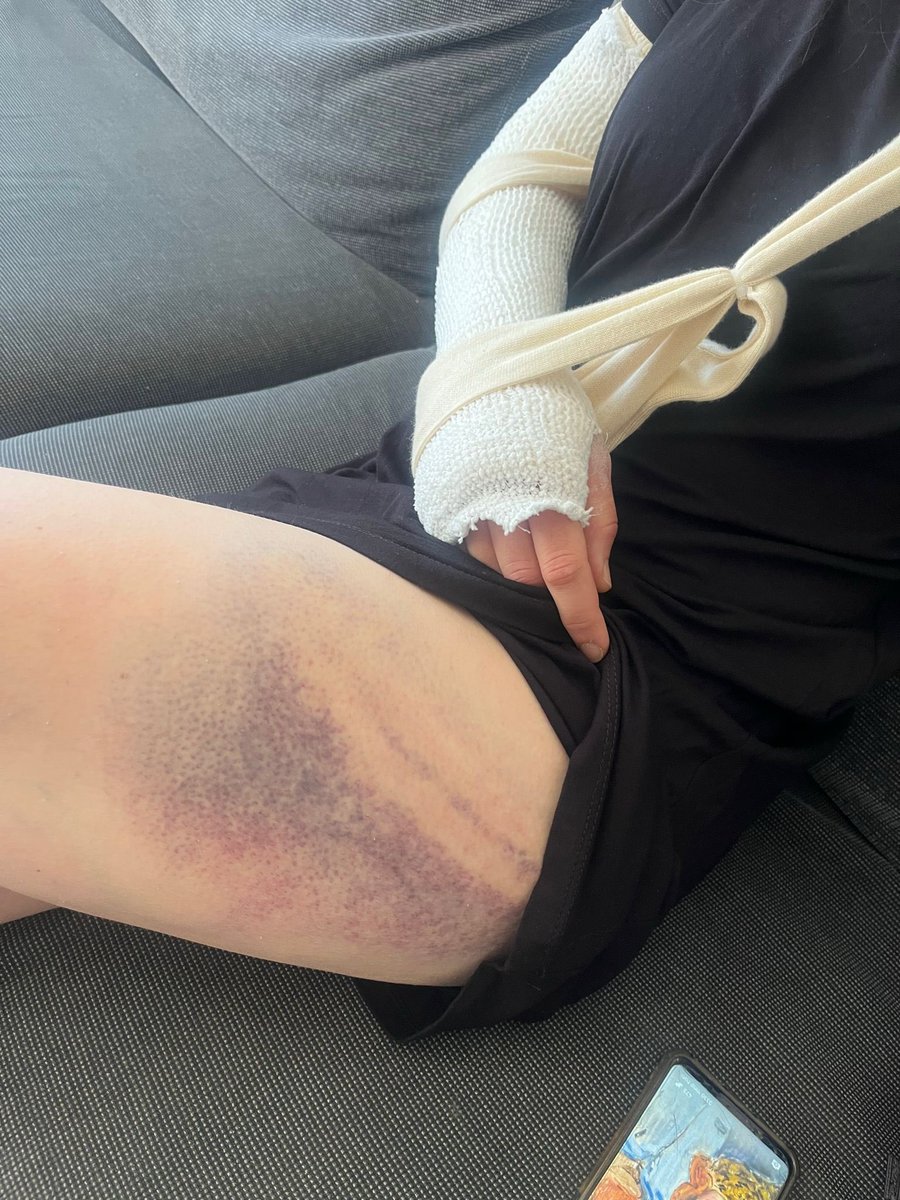 ככה נראים החברים שלי, שני סטודנטים בני 24, אחרי שמתנחלים הכו אותם באלות עד שהם שברו להם את המרפקים.

והם עוד יצאו בזול, כי לפני שהרביצו להם ירו לכיוונם בנשק חם!

המשטרה לא עוצרת, התקשורת לא מדווחת או חוקרת, המתנחלים ממשיכים באלימות. מעגל שלא עוצר.