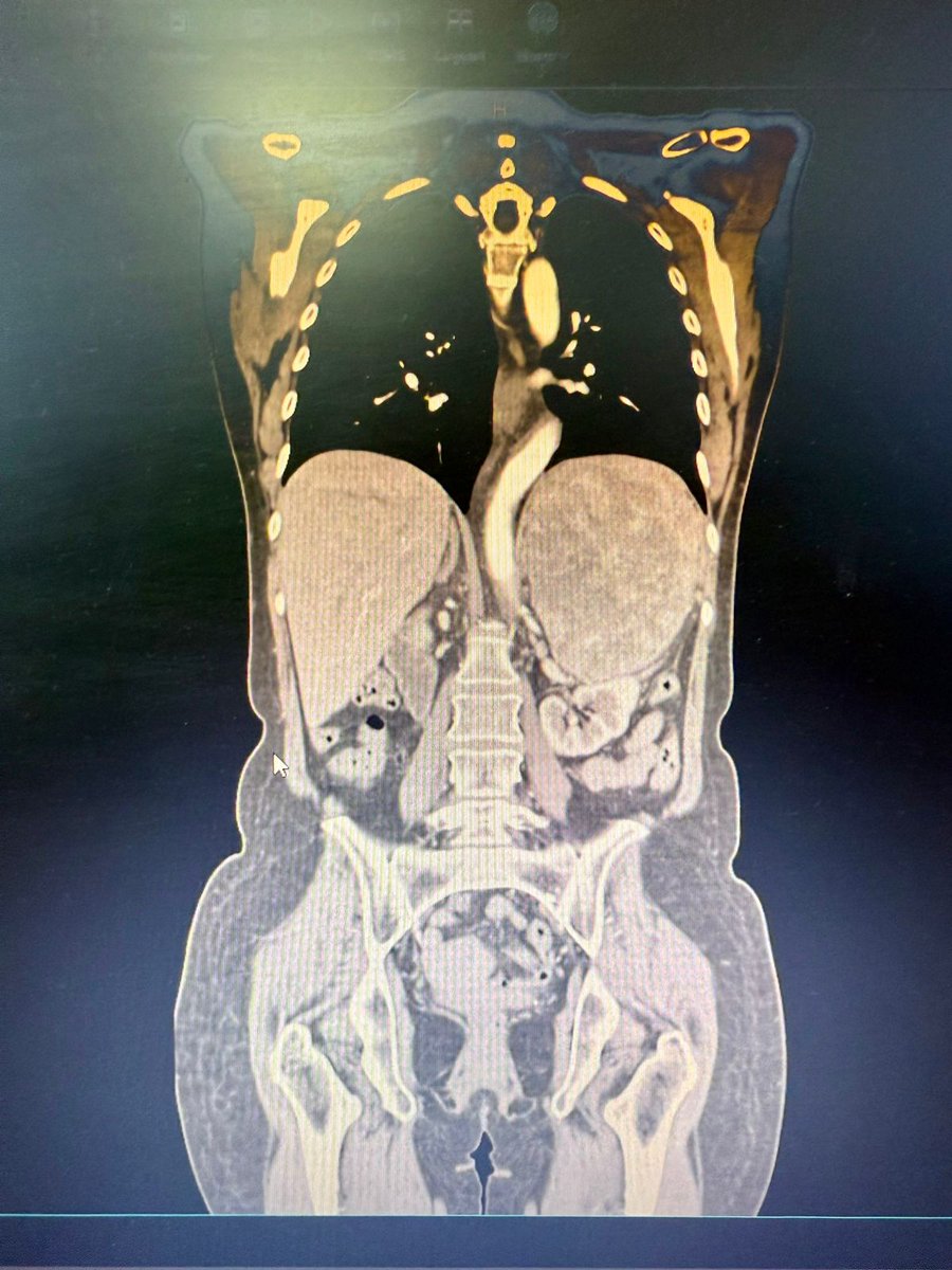 IPSParaguay's tweet photo. 🏥 Realizan inédita cirugía de extirpación de tumor en glándula suprarrenal en el Hospital Quirúrgico IPS Ingavi

Más info https://t.co/LBAMx5jMEy https://t.co/sUT6JTTQjL