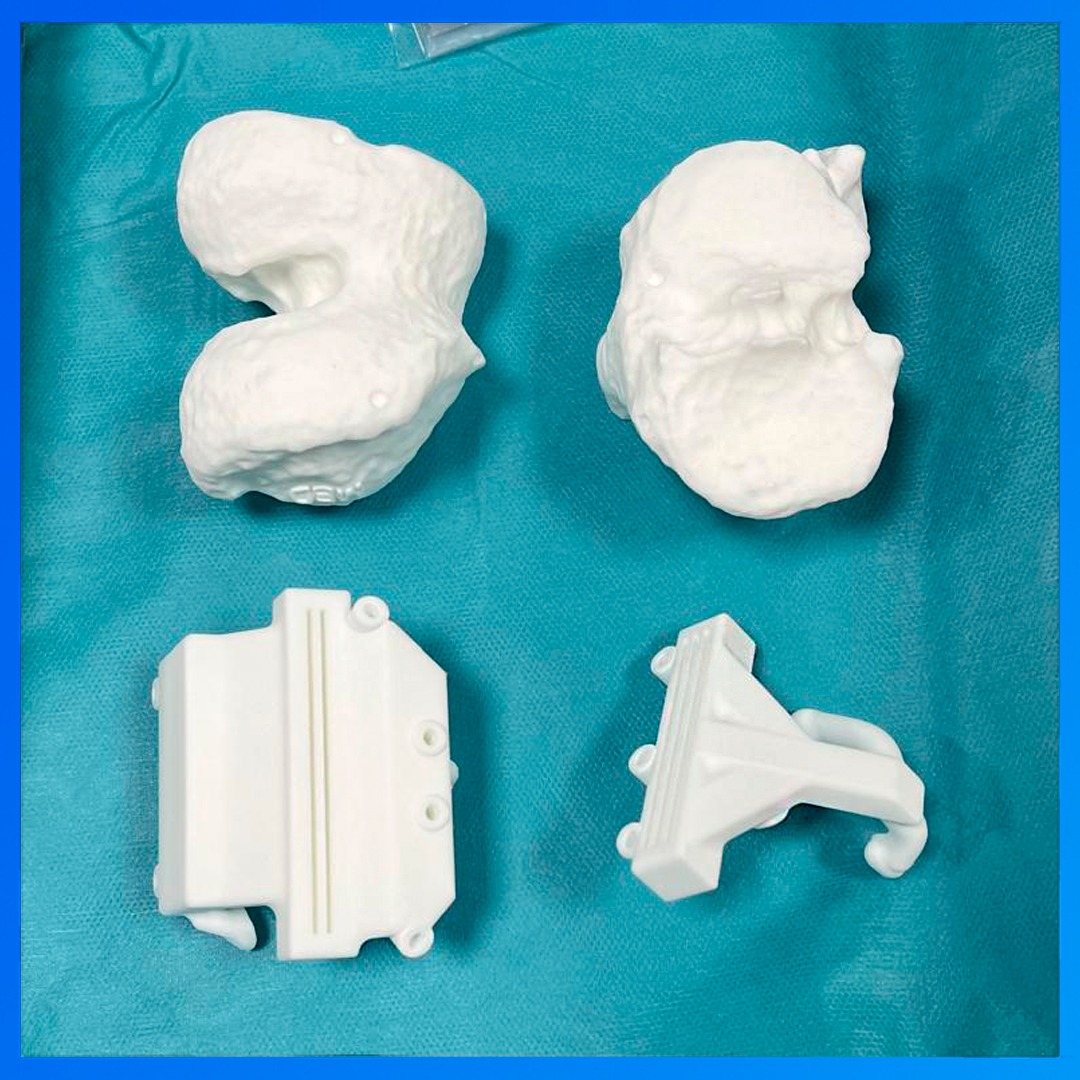 medcomtech_sa's tweet photo. Dr. Lluís Puig Verdié en el H. Quirónsalud Barcelona, operó a un paciente de 74 años, con clavo femoral de una anterior cirugía. Se diseñaron guías personalizadas + inserción del implante de rodilla U2™ de United Orthopedic Corporation. Todos los productos distr. por #medcomtech https://t.co/iVSFwVdI7H