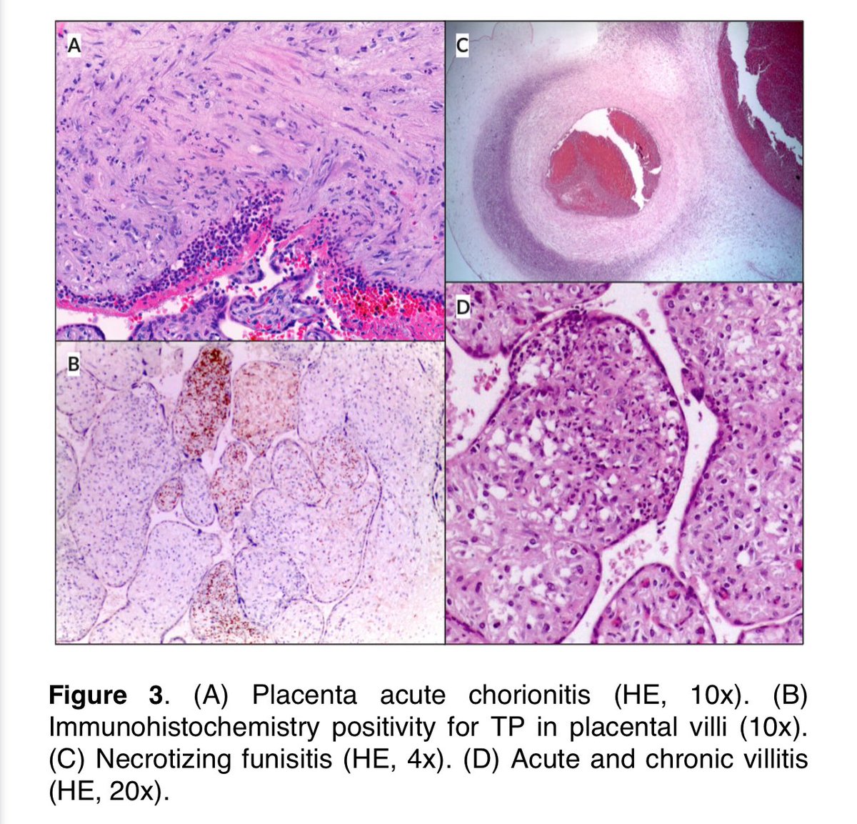 PediDevPath's tweet image. 🚨 New podcast episode!
Hear about the collaborative #PediPath network in Portugal that created this updated view of congenital syphilis!
pedidevpath.podbean.com
Free article access until June 27:
journals.sagepub.com/doi/full/10.11…