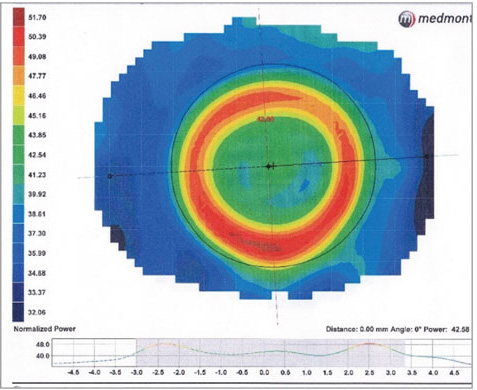 revoptom's tweet image. Study: Ortho-K Lenses with Smaller Optical Zone Diameter May Provide Better Myopia Control

This should be weighed against the drawback, however, of increased rates of higher-order aberrations, potentially affecting visual quality.
reviewofoptometry.com/news/article/s…
#myopiacontrol #myopia