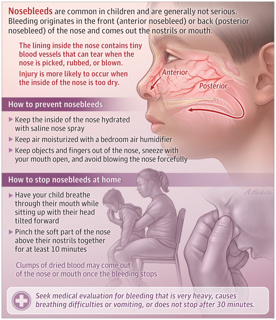 Although annoying, nosebleeds (also called epistaxis) are generally not serious. 

This JAMA Otolaryngology–Head &amp; Neck Surgery Patient Page describes the symptoms and treatment of nosebleeds. ja.ma/4jMO4h2