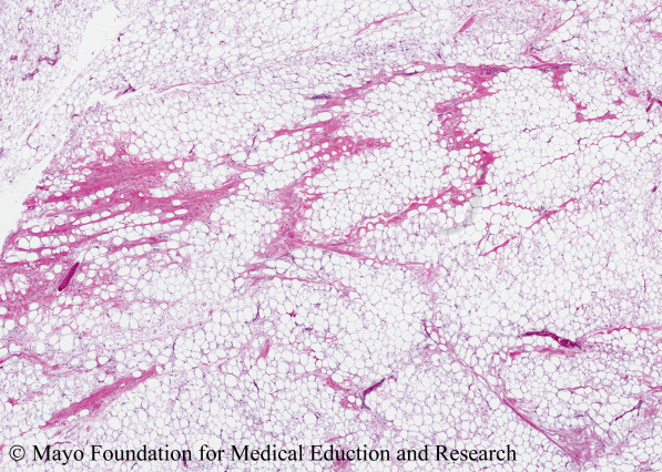 Path to Patient image quiz: The tumor showed MDM2 gene rearrangement, and on pathologic examination, the tumor was diagnosed as an atypical lipomatous tumor/low-grade liposarcoma.
mayocl.in/4l7VdK0