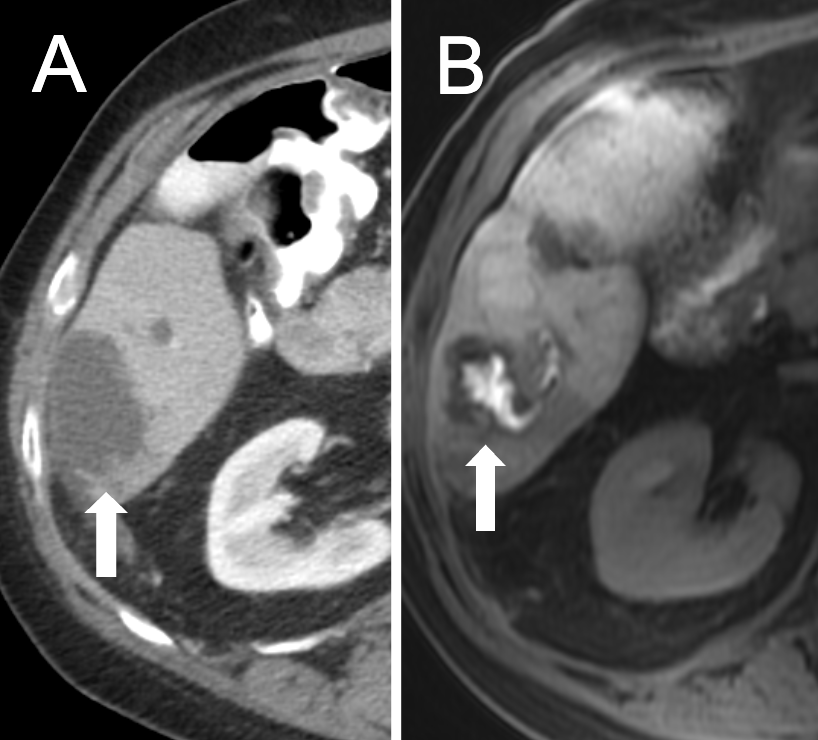 MedBlendPub's tweet image. #Case_of_the_Day
A 45YO F with colorectal liver mets developed a new seg 6 lesion post hepatic artery pump placement.
(B) shows HBP-aMRI following HB-specific agent injection
📍Dx?
Answer 👉 medblendpublishing.com
#Radiology #LiverImaging #AbdominalImaging #RadRes #MedEd