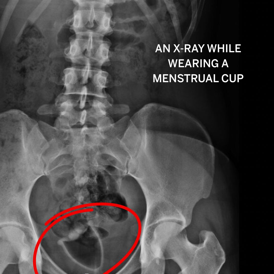 I got to thinking...how does a menstrual cup actually sit in the vaginal canal? Like, realistically, not just on an anatomy model. Well, I scrolled across this image and found out that tampons and menstrual cups show up on an X-ray!