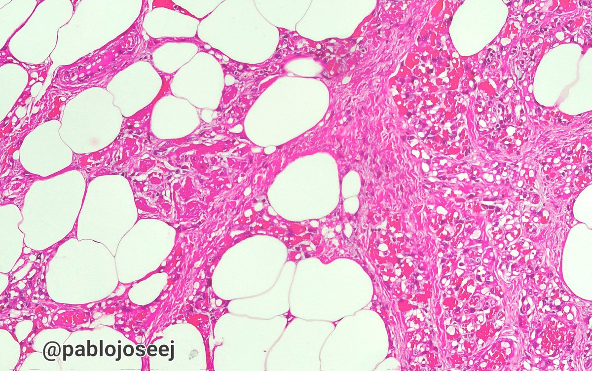 🩸Angiolipoma (cellular).
⁃ Mature adipose tissue and branching
capillary vessels.
⁃ Intraluminal fibrin thrombi.
Nodules are usually multiple and painful
#Pathology #AnatomiaPatologica
#BSTpath #PathArt #Medicine