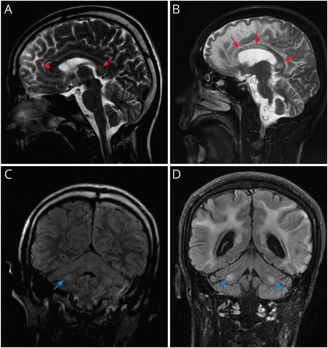 Imaging spectrum of CSF1R-related leukoencephalopathy <a href="/GreenJournal/">Neurology Journal</a> 
- Antero-posterior progressive WM changes
- Diffusion restriction
- Corpus callosum
- MCP, Cerebellar WM
doi.org/10.1212/WNL.00…