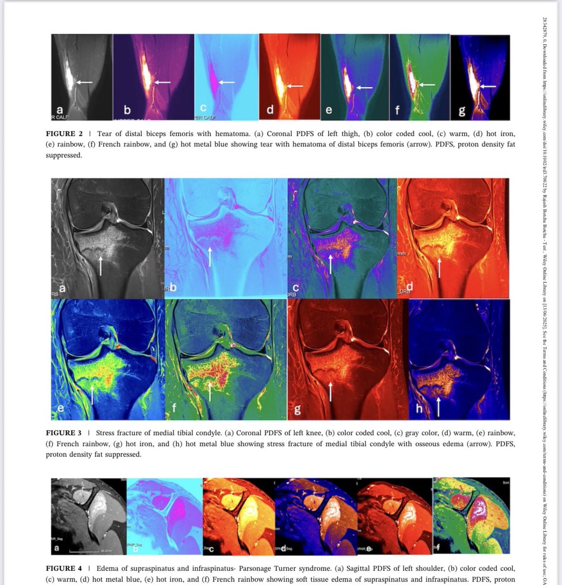 mskradiology4u (@mskradiology4u1) on Twitter photo Happy to share my 399th publication
doi.org/10.1002/ird3.7…
<a href="/samrad77/">Sameer Raniga</a> <a href="/BSSR_Site/">BSSR</a> <a href="/intskeletal/">International Skeletal Society | ISS</a> <a href="/ESSRmsk/">European Society of Musculoskeletal Radiology</a> <a href="/MSKSocietyIndia/">MSS India</a> <a href="/ROHImaging/">ROHImaging</a> <a href="/ROHNHSFT/">The Royal Orthopaedic Hospital</a> <a href="/Heath_Lodge/">Heath Lodge Clinic</a> Happy to share my 399th publication
doi.org/10.1002/ird3.7…
<a href="/samrad77/">Sameer Raniga</a> <a href="/BSSR_Site/">BSSR</a> <a href="/intskeletal/">International Skeletal Society | ISS</a> <a href="/ESSRmsk/">European Society of Musculoskeletal Radiology</a> <a href="/MSKSocietyIndia/">MSS India</a> <a href="/ROHImaging/">ROHImaging</a> <a href="/ROHNHSFT/">The Royal Orthopaedic Hospital</a> <a href="/Heath_Lodge/">Heath Lodge Clinic</a>