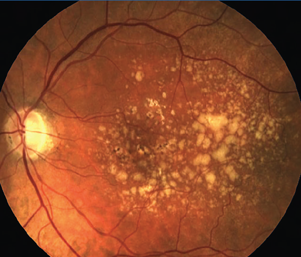 Lifestyle May Have a Bigger Impact on AMD than Fish Oil

A recent study presented at ARVO found that taking fish oil supplements doesn't help protect against new AMD: reviewofophthalmology.com/article/lifest…
#ophthalmology #ophthalmologist #AMD