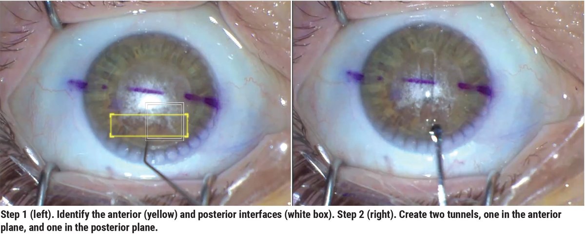 Double Tunnel Technique for SMILE

In this month's Refractive/Cataract Rundown, we take a closer look at a strategy that aims to simplify lenticule dissection: reviewofophthalmology.com/article/double…
#ophthalmology #ophthalmologist #eyecare #cataract #cataractsurgeon #cataractsurgery