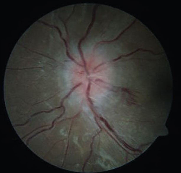 Ocular Findings in Pediatric Nutritional Deficiencies

Why ophthalmologists should consider these in their differential diagnosis: reviewofophthalmology.com/article/ocular…
#ophthalmology #ophthalmologist #eyecare #eyehealth