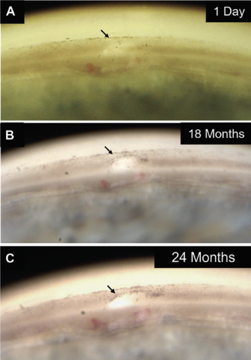 Laser-based Glaucoma Treatments

As data matures, these innovations in treating outflow may redefine first-line and adjunctive glaucoma therapy in the clinic: reviewofophthalmology.com/article/laserb…
#ophthalmology #ophthalmologist #eyecare #glaucoma #glaucomasurgery #glaucomaspecialist