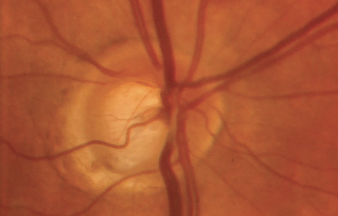 Gum Disease/Glaucoma Connection Investigated

Inflammation plays a major role in periodontitis, and recent findings have suggested that patients with this gum disease may also be at higher risk of glaucoma development and progression: reviewofophthalmology.com/article/gum-di…
#ophthalmology