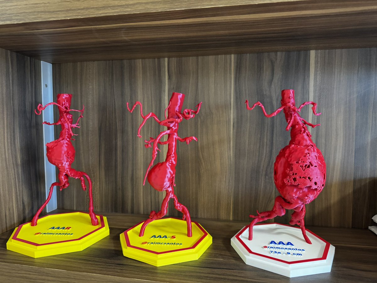 raimcsantos's tweet photo. Abdominal aortic aneurysms - Saccular 7 cm, saccular 6.0 cm and fusiform 9.0 cm.
#AortaEd #VascularEd #MedTwitter #cardiotwitter #CardioEd #3DPrinting #Technology https://t.co/juh8OZdJDx