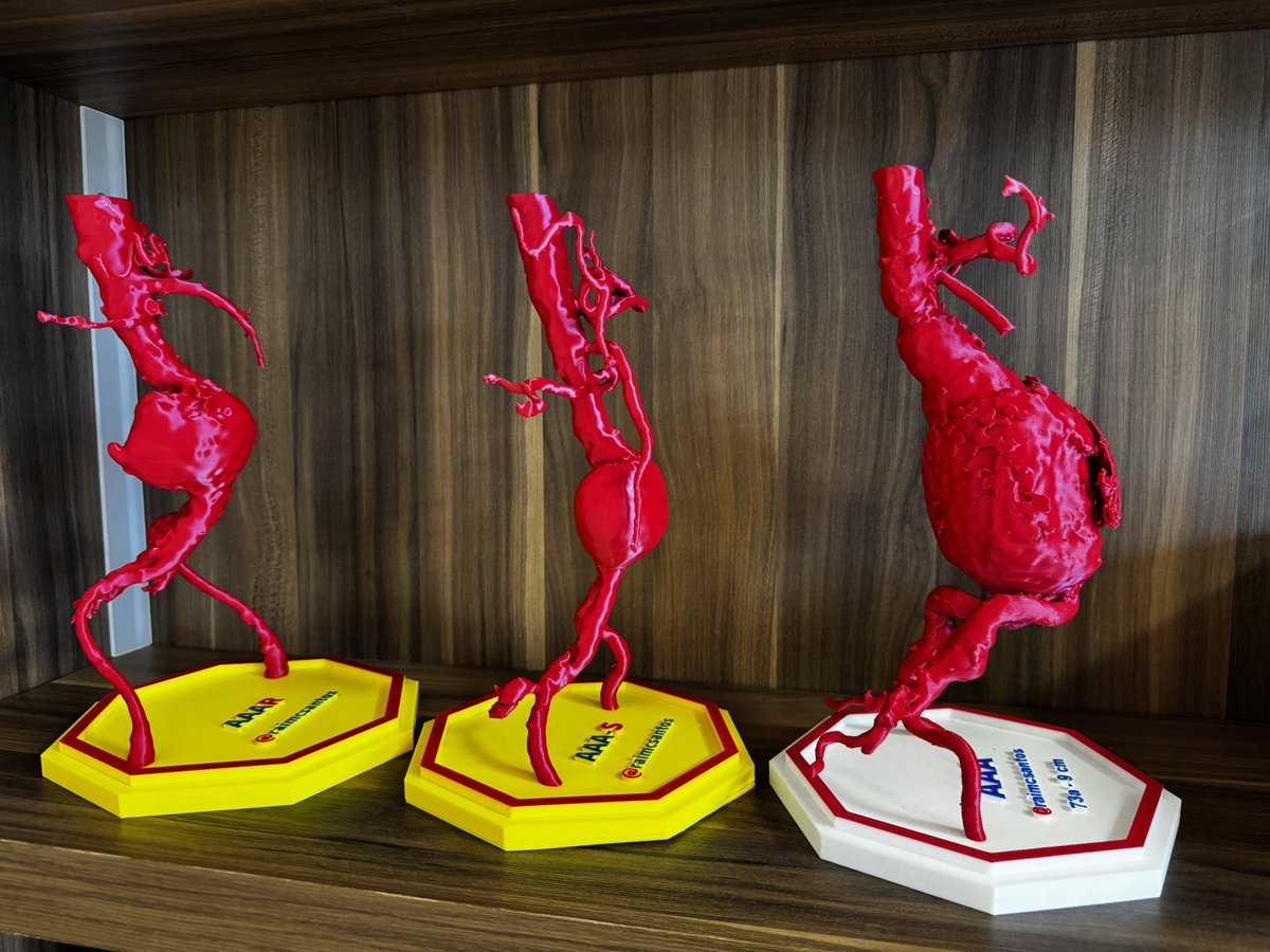 Abdominal aortic aneurysms - Saccular 7 cm, saccular 6.0 cm and fusiform 9.0 cm.
#AortaEd #VascularEd #MedTwitter #cardiotwitter #CardioEd #3DPrinting #Technology