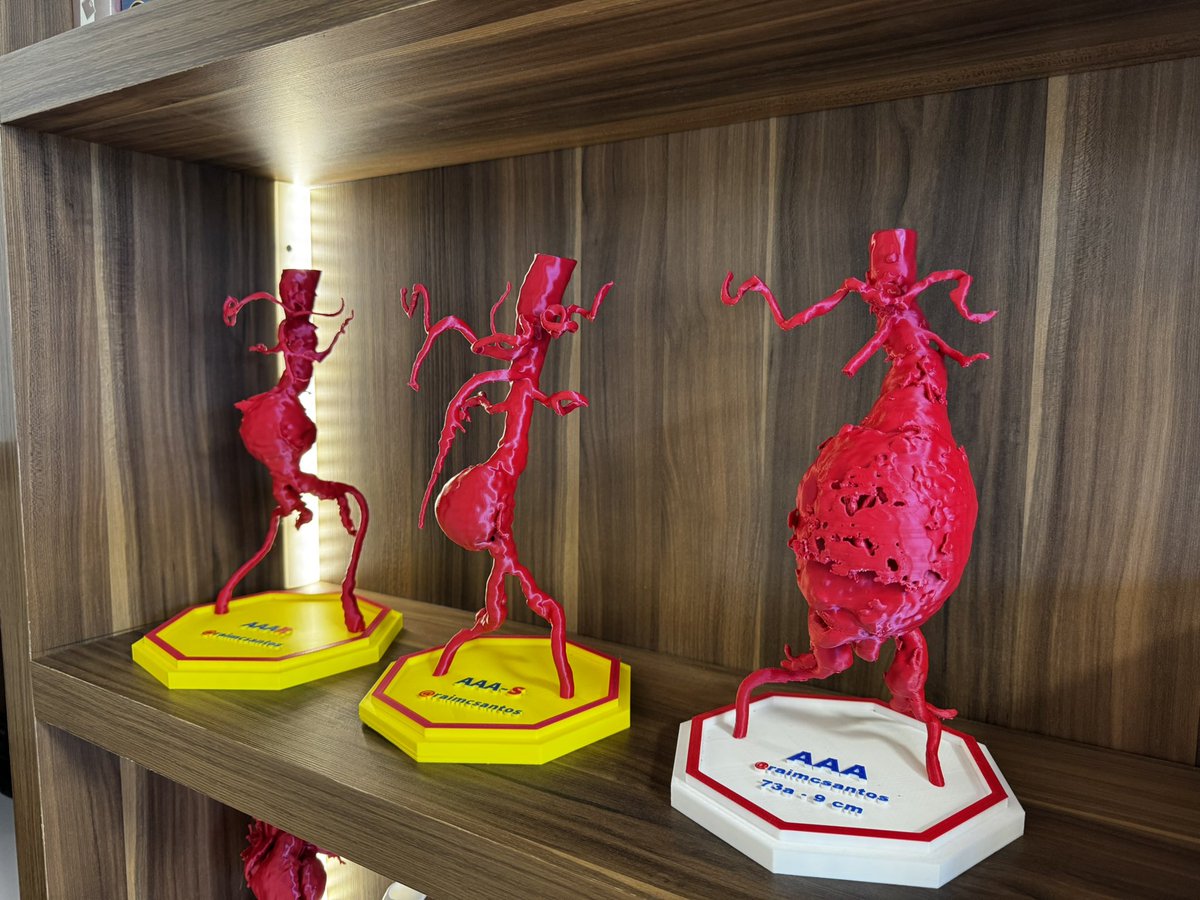 raimcsantos's tweet photo. Abdominal aortic aneurysms - Saccular 7 cm, saccular 6.0 cm and fusiform 9.0 cm.
#AortaEd #VascularEd #MedTwitter #cardiotwitter #CardioEd #3DPrinting #Technology https://t.co/juh8OZdJDx