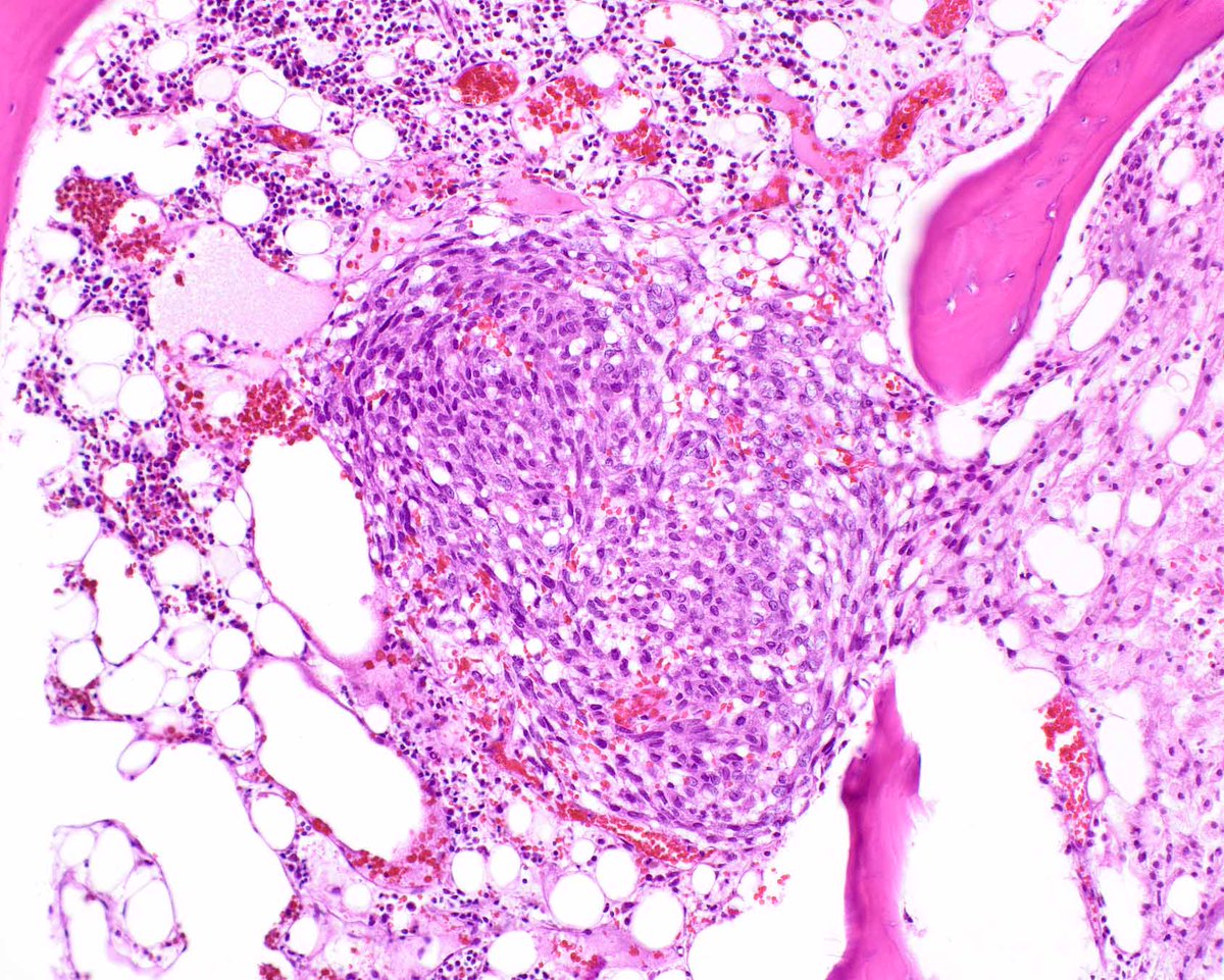 ModernPathology's tweet image. Once in a while gastrointestinal stromal tumors (GISTs) spread to bone!  Learn about GISTs in less common primary sites:
Gastrointestinal stromal tumors (GISTs) arising in uncommon locations: clinicopathologic features and risk assessment of esophageal, colonic, and appendiceal…