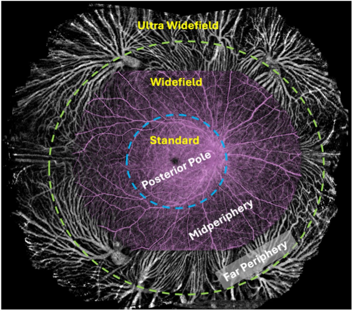 Yali Jia (@yalijiaoct) on Twitter photo <a href="/CaseyEye/">OHSU Casey Eye</a>’s fresh review paper “Widefield OCT Angiography” available on PRER Journal. Widefield guideline, technical innovations, clinical utility and more….sciencedirect.com/science/articl… <a href="/CaseyEye/">OHSU Casey Eye</a>’s fresh review paper “Widefield OCT Angiography” available on PRER Journal. Widefield guideline, technical innovations, clinical utility and more….sciencedirect.com/science/articl…