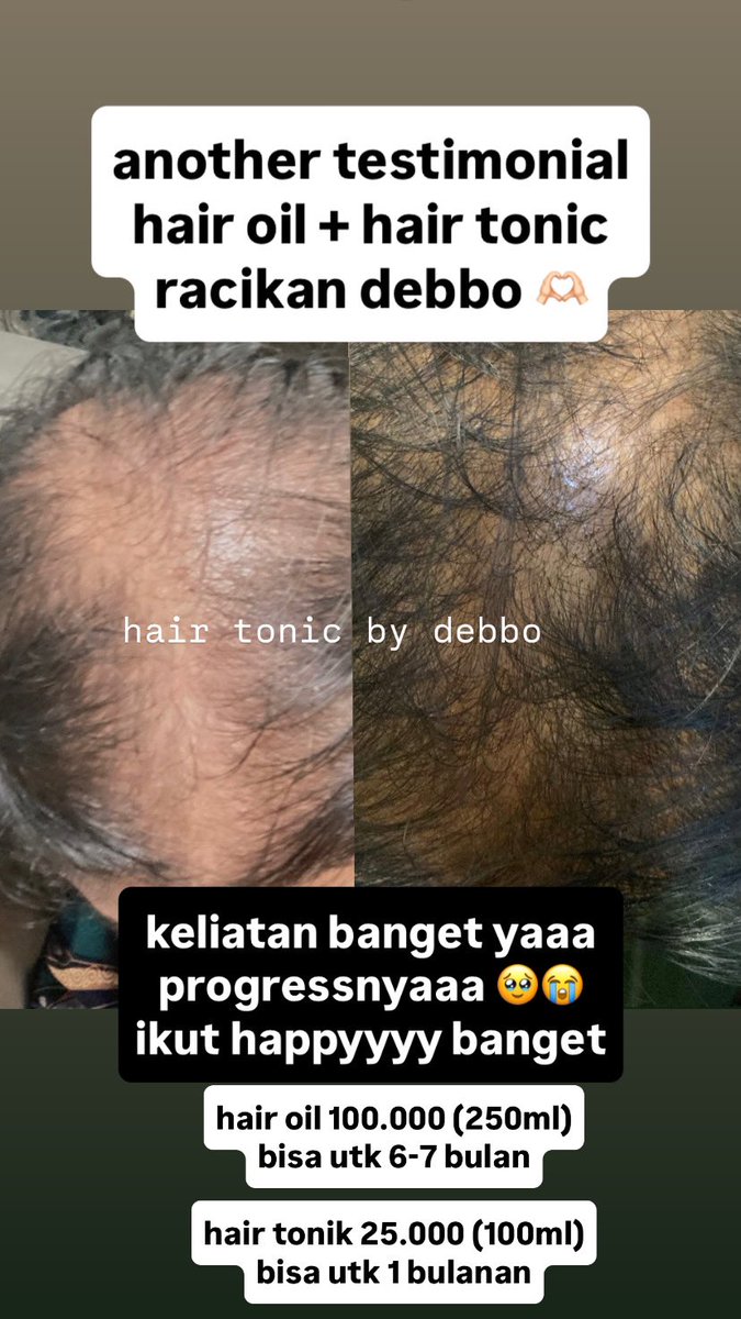 debbiiedebo's tweet photo. @onyourm_iaaa @tanyarlfes haloo cobain disemprotin rebusan daun rosemary sis. aku pake uda bertahun2 sangat works, dan uda bantu temenku banyak banget. resep &amp; benefit rebusan rosemary banyak d tiktok. tp kalo nda sempat bisa cek igku @debbiiedebo aku suka bantu bikinin dg fee 25k doang https://t.co/4Yhzs0uCXT