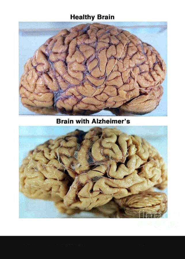 MetabolicFactor's tweet image. Everyone wants to sculpt their body...
But hardly anyone trains the one organ that runs everything.

You won’t notice your brain failing—until it does:
Mental fatigue. Low mood. Scattered thoughts.

Here’s how to nourish, rewire, and protect your brain 🧵