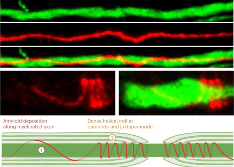 Jaime Grutzendler (@jgrutzendler) on Twitter photo 1/ I am happy to share our latest  publication in Nature Neuro   nature.com/articles/s4159…. We present the first subcellular proteomic atlas of the myelin–axon interface in human and mouse brain, revealing extensive Alzheimer‑related abnormalities. 1/ I am happy to share our latest  publication in Nature Neuro   nature.com/articles/s4159…. We present the first subcellular proteomic atlas of the myelin–axon interface in human and mouse brain, revealing extensive Alzheimer‑related abnormalities.