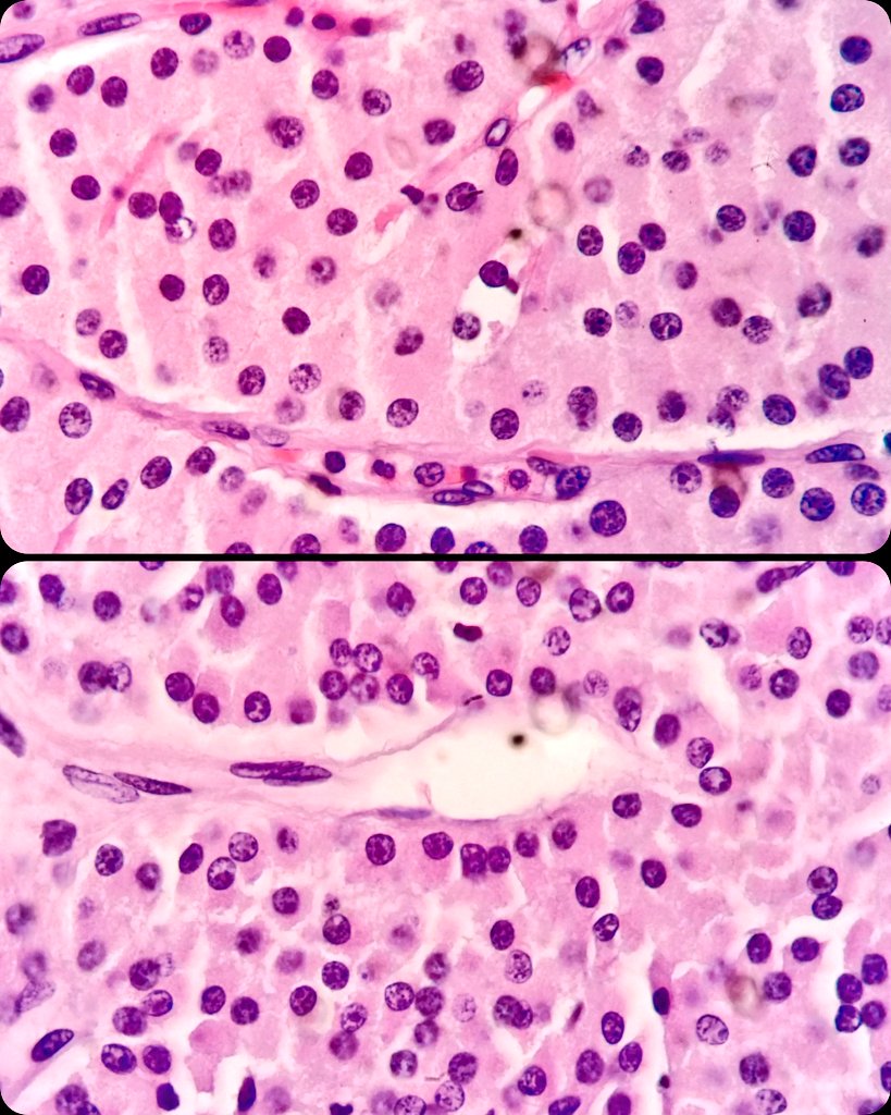 🫁 Lung nodule.
🔬 Metastatic Parathyroid Carcinoma.  Island - solid growth.  Uniform cells (Mostly chief cells).
➕ GATA3, PTH.

#LungPath #PathX #PathTwitter