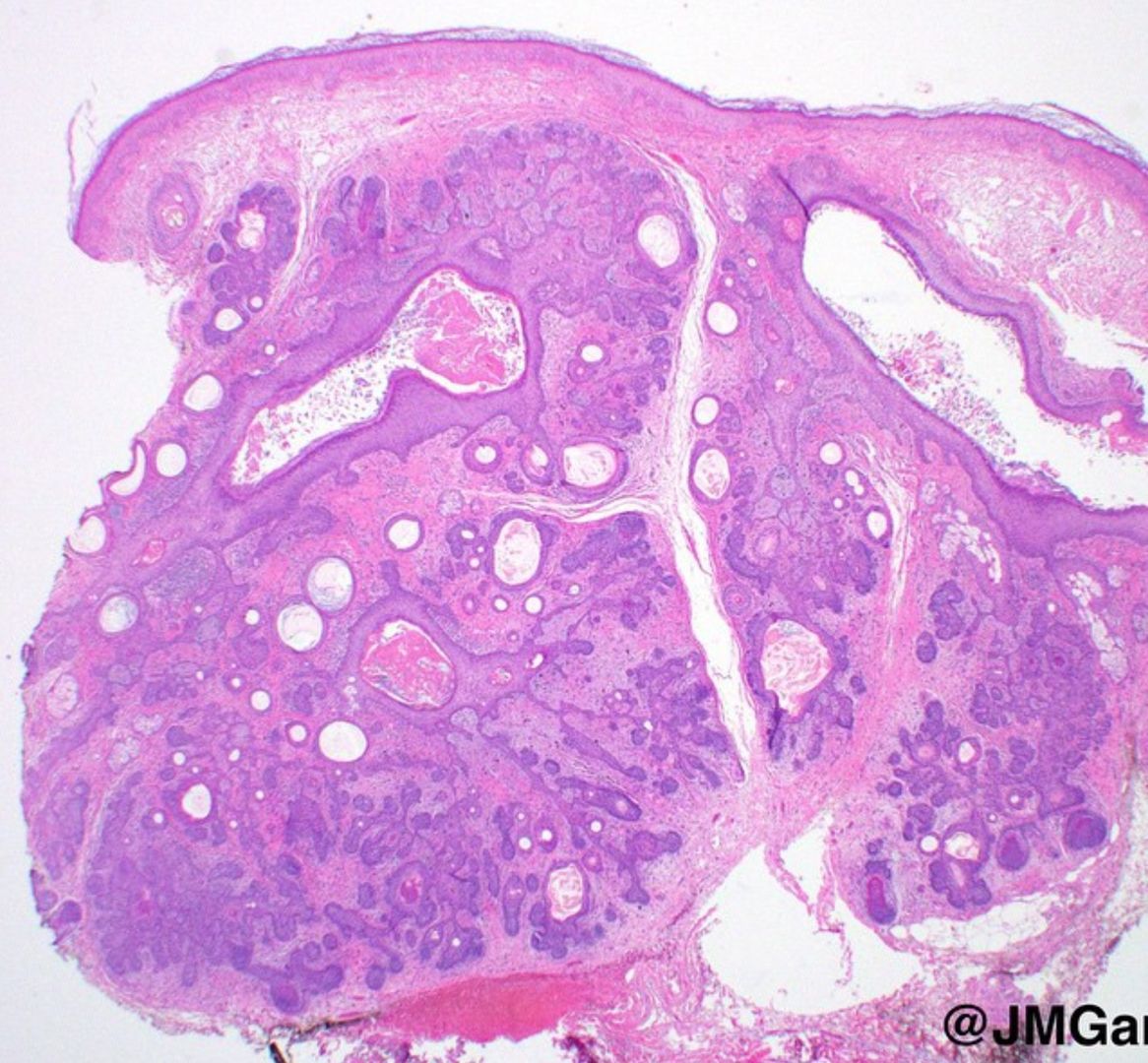 A #dermpath classic! Your diagnosis? 
Answer ✅  youtube.com/watch?v=wQlreS… 
More pics: kikoxp.com/posts/8476
#pathology #pathologists #pathTwitter #dermatology #dermatologia #dermtwitter