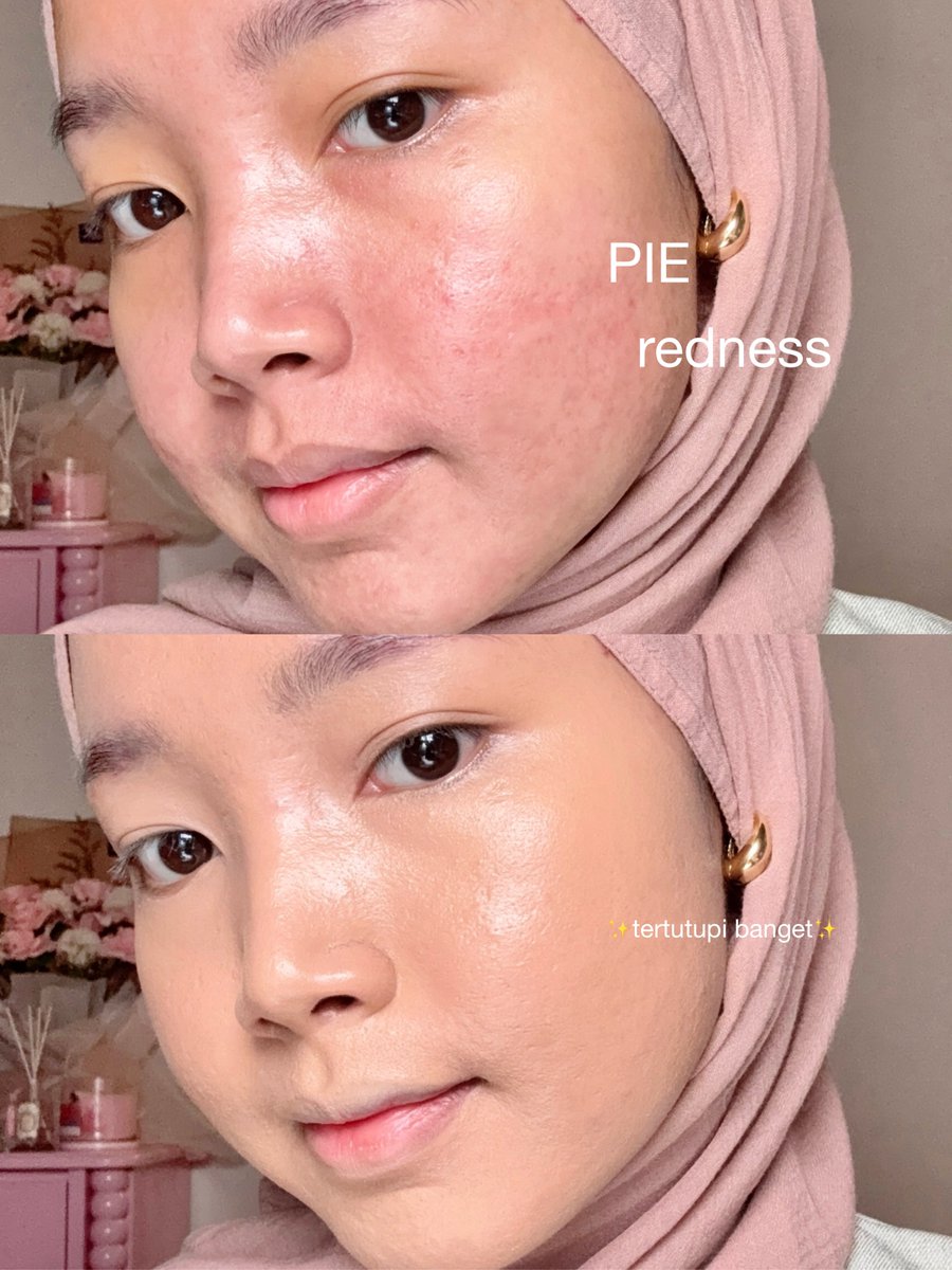 "MALES PAKE CUSHION HASILNYA GA FULL COVERAGE BUAT BEKAS JERAWAT"

aku mau kasih tau caranya pakai cushion biar hasilnya nutupin ✨bekas jerawat✨ dengan sempurna walaupun cuma 1x layer aja 👌🏻

hasil makeup jadi cakep bisa disimak 👇🏻
