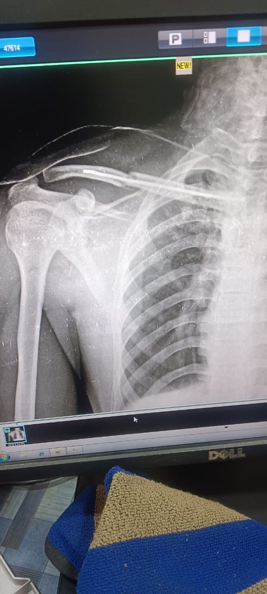 SBI ने बिना पूर्व सूचना ₹1000 काट लिए जब हम गंभीर स्वास्थ्य संकट से जूझ रहे हैं। मेरी पत्नी 8 माह की गर्भवती हैं, मेरे कंधे की हड्डी टूटी है। अब बैंक याेनो ऐप खोलो, यह करो वह करो — ऐसी बातें कर रहा है। हमें नहीं आता हमें हमारा पैसा वापस चाहिए कृपया मदद करें।  <a href="/TheOfficialSBI/">State Bank of India</a>