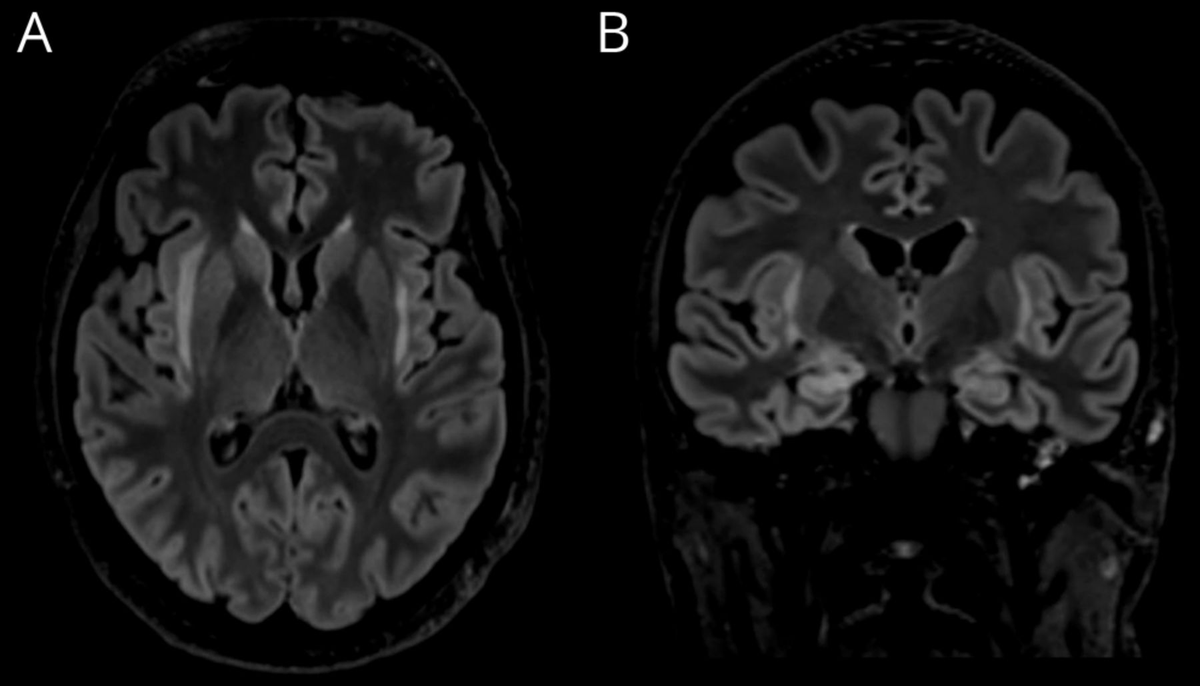 NeuroimagingDB's tweet photo. C-NORSE, also known as febrile infection-related epilepsy syndrome (FIRES)
✅両側claustrumのT2, FLAIR, DWI高信号が特徴（Claustrum sign）
✅海馬、基底核、視床、島皮質にも異常信号
✅びまん性の髄軟膜肥厚があることも
PMID: 34937779 https://t.co/NDrJt2Nd55