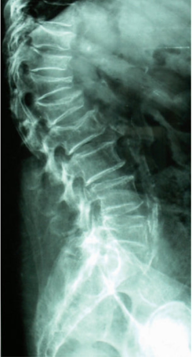 doctorneyro's tweet image. Hoy es #FelizDomingo y tienes #tiempoparaleer.

Dedica #10minutos para esta (magnífico( #resumen sobre #osteoporosis por #2expertos y además, muy buenas gentes.

#Merecelapena.

academia.edu/113401621/Oste…