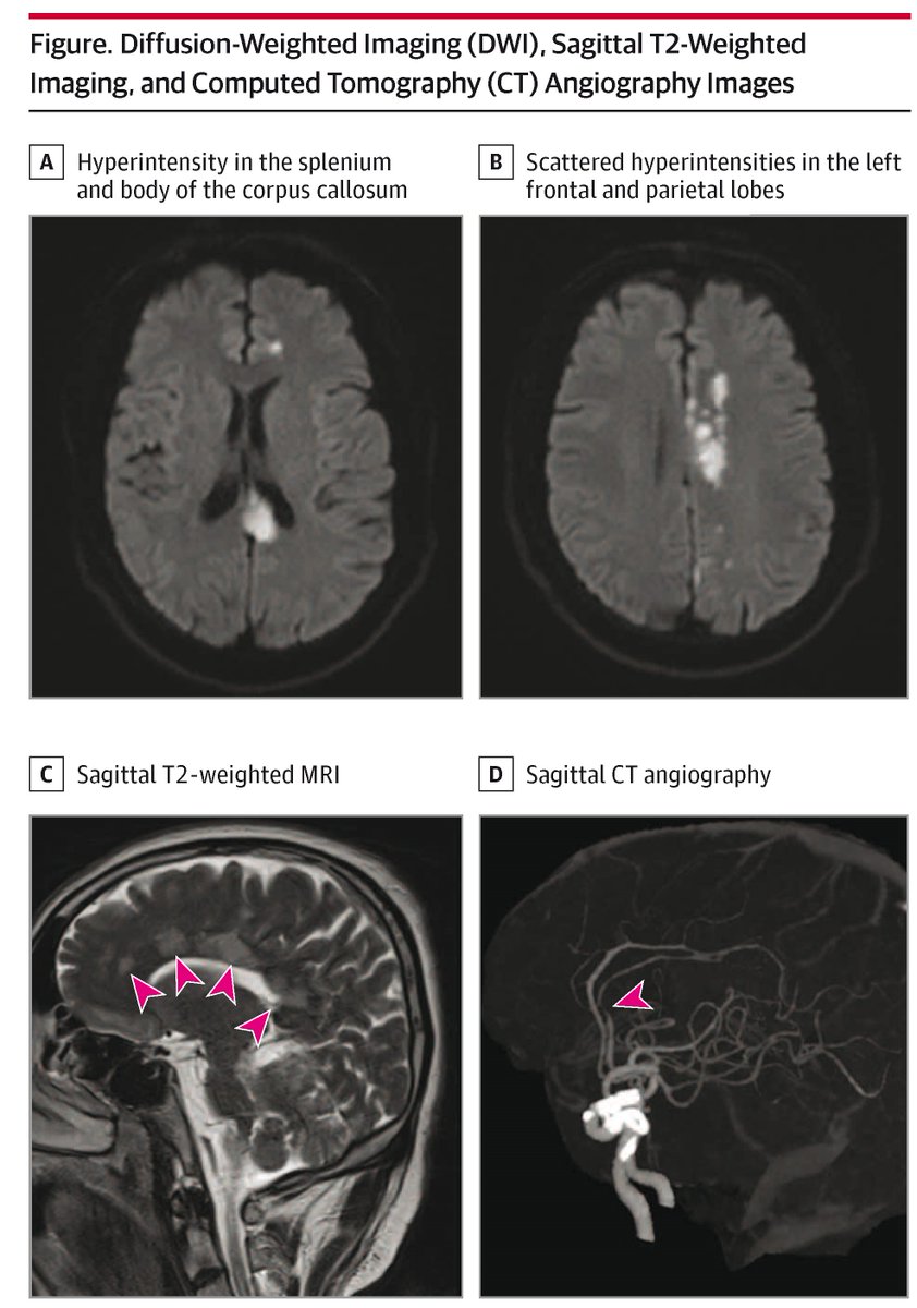 Belly dancer’s dyskinesia (BDD) is a rare movement disorder involving involuntary abdominal muscle contractions, potentially linked to central nervous system issues. 

Learn more in this case report: ja.ma/4e2Ca15