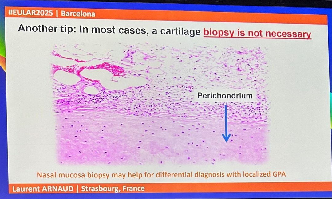 Relapsing polychondritis from #EULAR2025:

👂 Cartilage inflammation sparing the earlobe is a major clue
🫁 Circumferential tracheal thickening favors RP over GPA
📋 Always consider systemic signs: hematologic, skin, cardiovascular
❗ Don’t miss VEXAS in the differential!