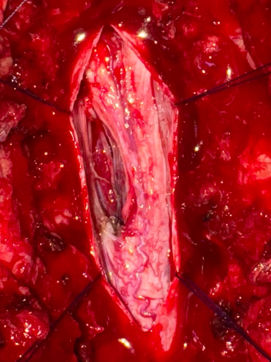 Before and After Spine Tumor surgery 
Image 1 - Can you spot the tumor in the spine 
Image 2 - After Tumor Removal 
Beautiful spinal Cord