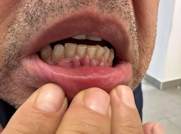 المريض جاك للطوارئ 
ضغطه مرتفع جدا ٢٠٠ / ١٢٠

لما سالته عن الادوية اللي ياخذها 
قالك ان الدواء ناسيه في البيت ومايعرف اسمه

فتحت فمه ولقيت هالمنظر 
ايش اسم الدواء اللي ناسيه في البيت ؟